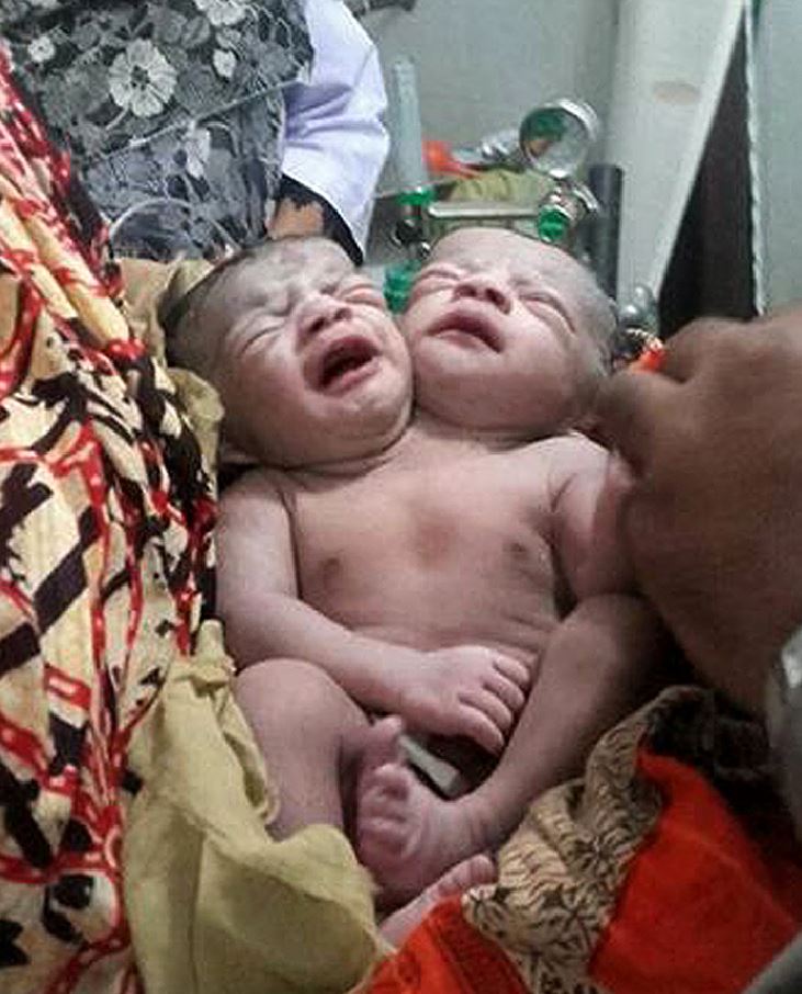 Nace un niña con dos cabezas en Bangladesh